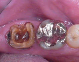 虫歯の写真