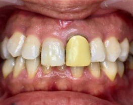 経年劣化の歯