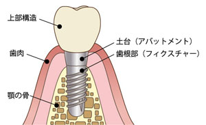 インプラントの特徴