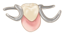 部分入れ歯