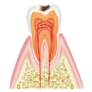 虫歯の進行状況