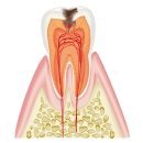 虫歯（C1）
