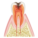 虫歯（C2）