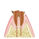 虫歯（C3）