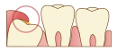 親知らずの症状
