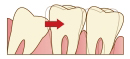 親知らずの症状