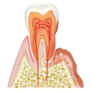 歯周病の進行状況