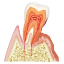 歯周病原因