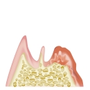 歯周病原因