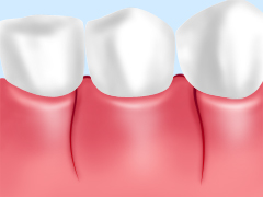 歯周病治療